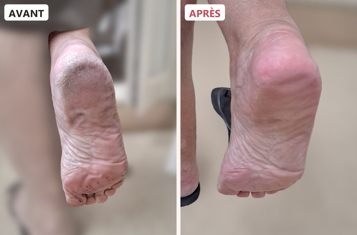 Avant / après une séance avec Velours Nomade chez Carmen, 72 ans : la plante du pied grisâtre et sèche devient nette et douce.