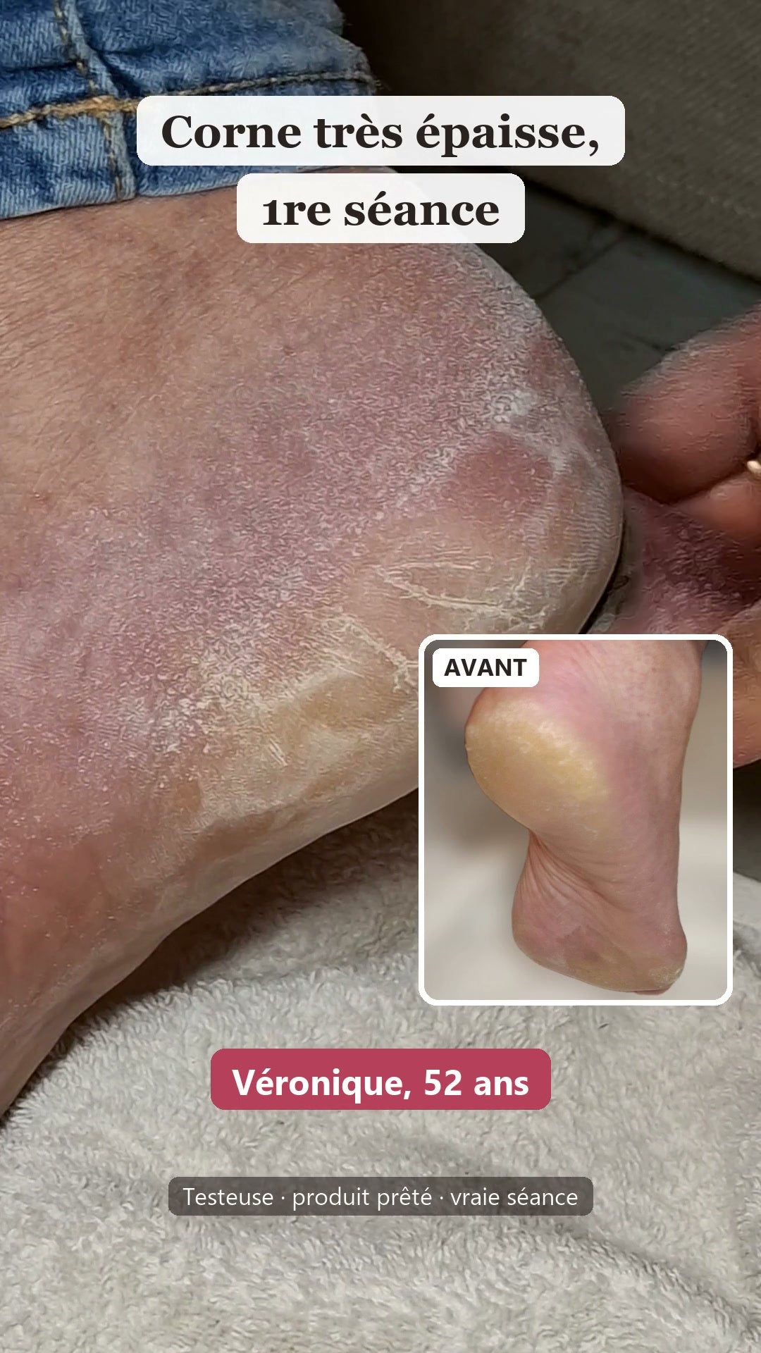 Vidéo d'une vraie séance avec Velours chez deux testeuses, Véronique 52 ans et Carmen 72 ans : la corne épaisse du talon part en poussière, puis leurs photos avant / après une seule séance.
